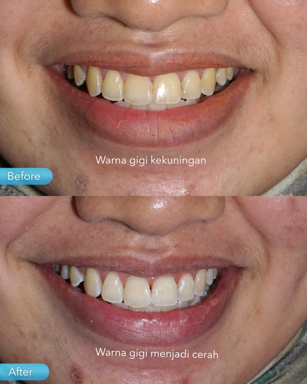 Teeth whitening result